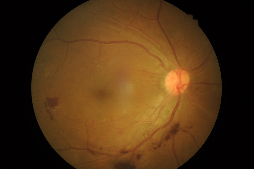 retinopatia di valsalva