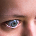 malattia oculare tiroidea