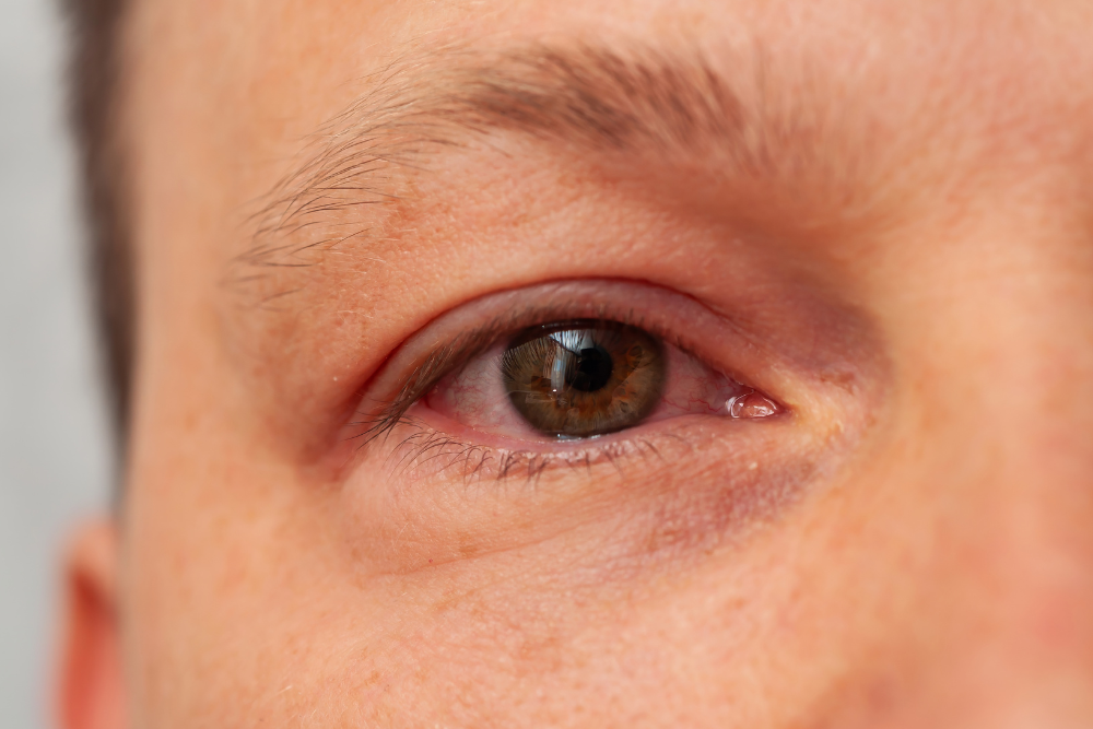 congiuntivite virale